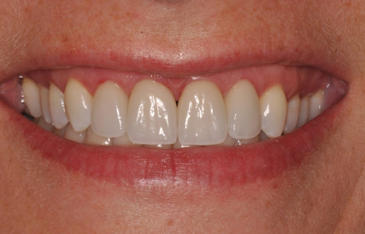 Tooth Colored Composite Resin Fillings Redwood